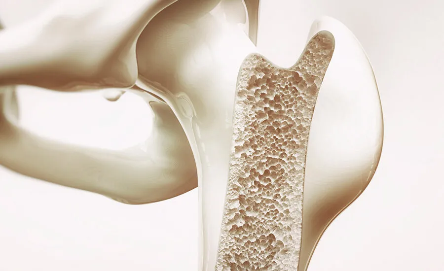 Osteoporose: Como saber se você está em risco
